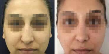 rhinoplasty colombia 342-1-min