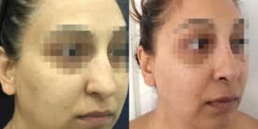 rhinoplasty colombia 342-2-min