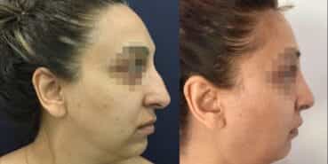 rhinoplasty colombia 342-3-min