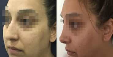 rhinoplasty colombia 342-4 (1)-min