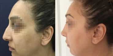 rhinoplasty colombia 342-5-min