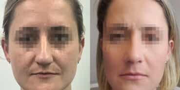 rhinoplasty colombia 367-1-min