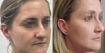 rhinoplasty colombia 367-2-min