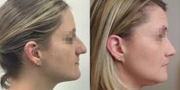 rhinoplasty colombia 367-3-min