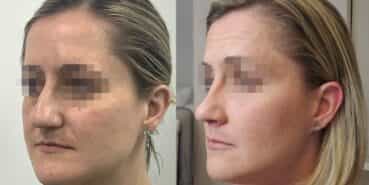 rhinoplasty colombia 367-4-min