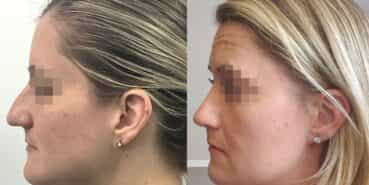 rhinoplasty colombia 367-5-min