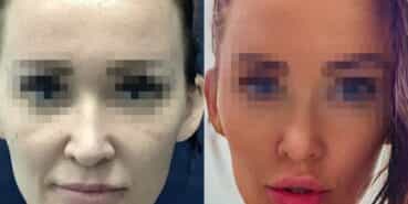 rhinoplasty colombia 370-1-min