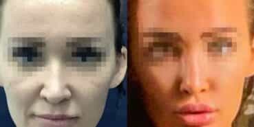 rhinoplasty colombia 370-2-min