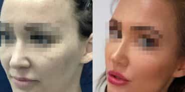 rhinoplasty colombia 370-3-min