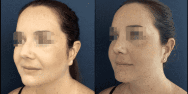 rhinoplasty colombia 827 - 2