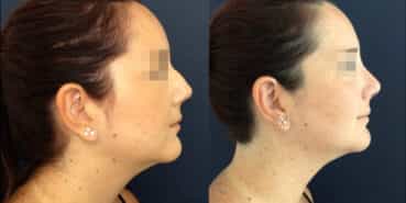 rhinoplasty colombia 827-3