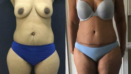 tummy tuck colombia 101-1-min