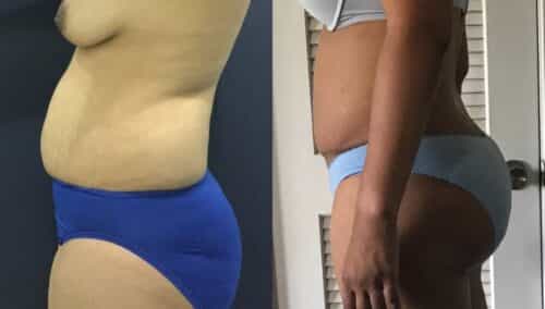 tummy tuck colombia 101-2-min
