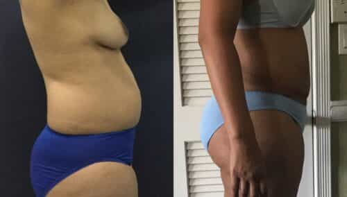 tummy tuck colombia 101-3-min