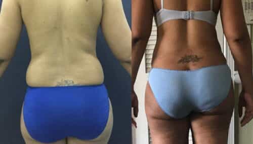 tummy tuck colombia 101-4-min