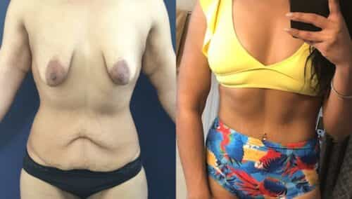 tummy tuck colombia 106-1-min