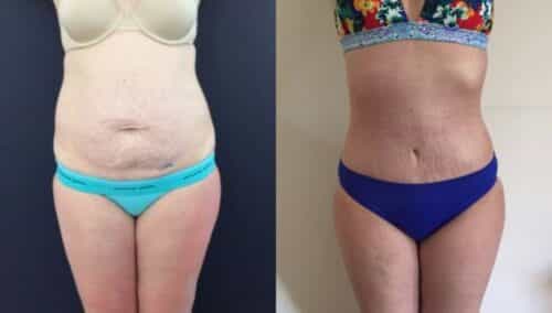 tummy tuck colombia 143-1-min