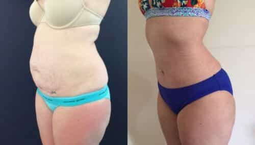 tummy tuck colombia 143-2-min
