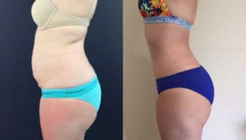 tummy tuck colombia 143-3-min