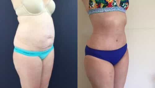 tummy tuck colombia 143-4-min