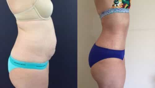 tummy tuck colombia 143-5-min