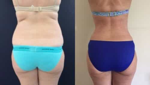 tummy tuck colombia 143-6-min