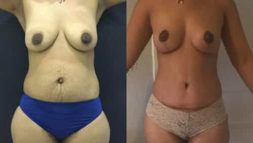 tummy tuck colombia 201-1-min