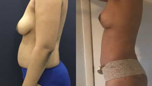 tummy tuck colombia 201-2-min