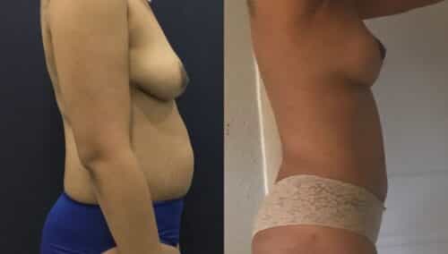 tummy tuck colombia 201-3-min