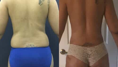 tummy tuck colombia 201-4-min