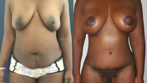 tummy tuck colombia 205-1-min