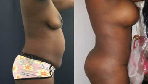 tummy tuck colombia 205-2-min