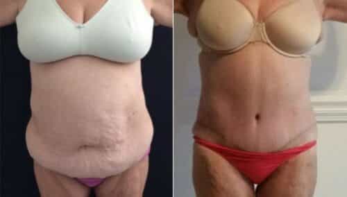tummy tuck colombia 221-1-min