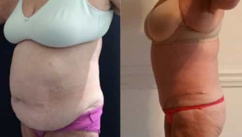 tummy tuck colombia 221-2-min