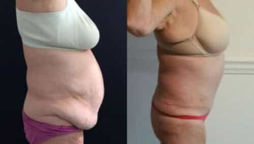 tummy tuck colombia 221-3-min