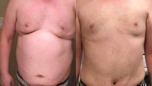 tummy tuck colombia 222-1-min