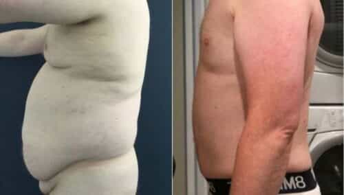 tummy tuck colombia 223-1-min