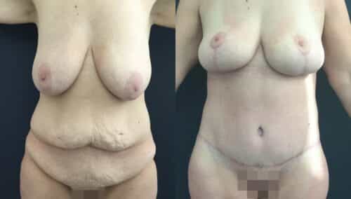 tummy tuck colombia 226-1-min