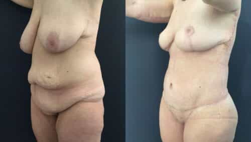 tummy tuck colombia 226-2-min