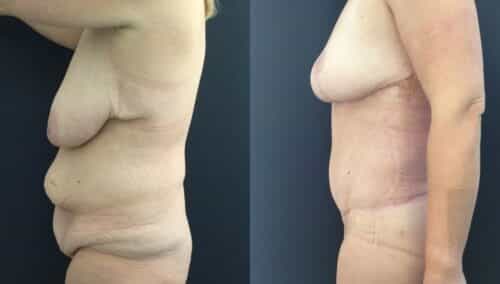 tummy tuck colombia 226-3-min