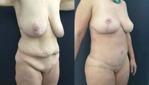 tummy tuck colombia 226-4-min