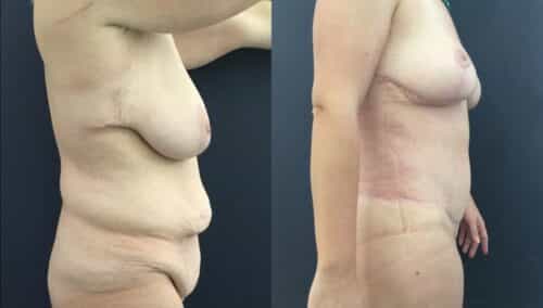 tummy tuck colombia 226-5-min
