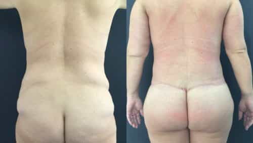 tummy tuck colombia 226-6-min