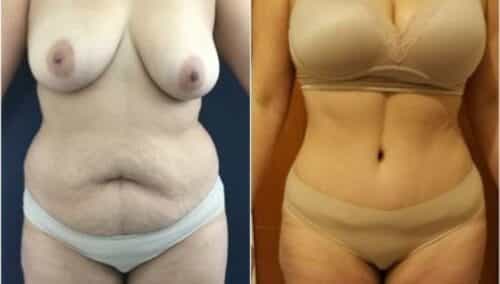 tummy tuck colombia 229-1-min