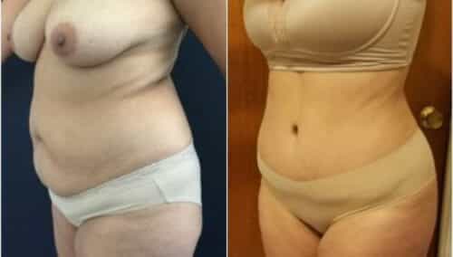 tummy tuck colombia 229-2-min