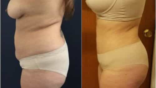 tummy tuck colombia 229-3-min