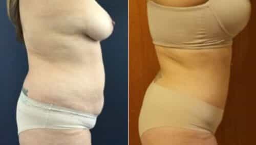tummy tuck colombia 229-4-min