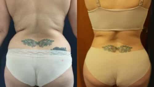 tummy tuck colombia 229-5-min
