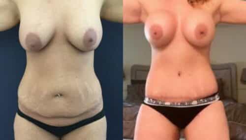 tummy tuck colombia 235-1-min