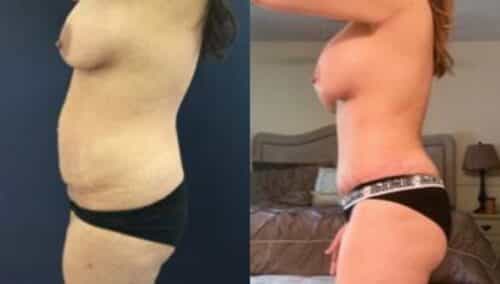 tummy tuck colombia 235-2-min